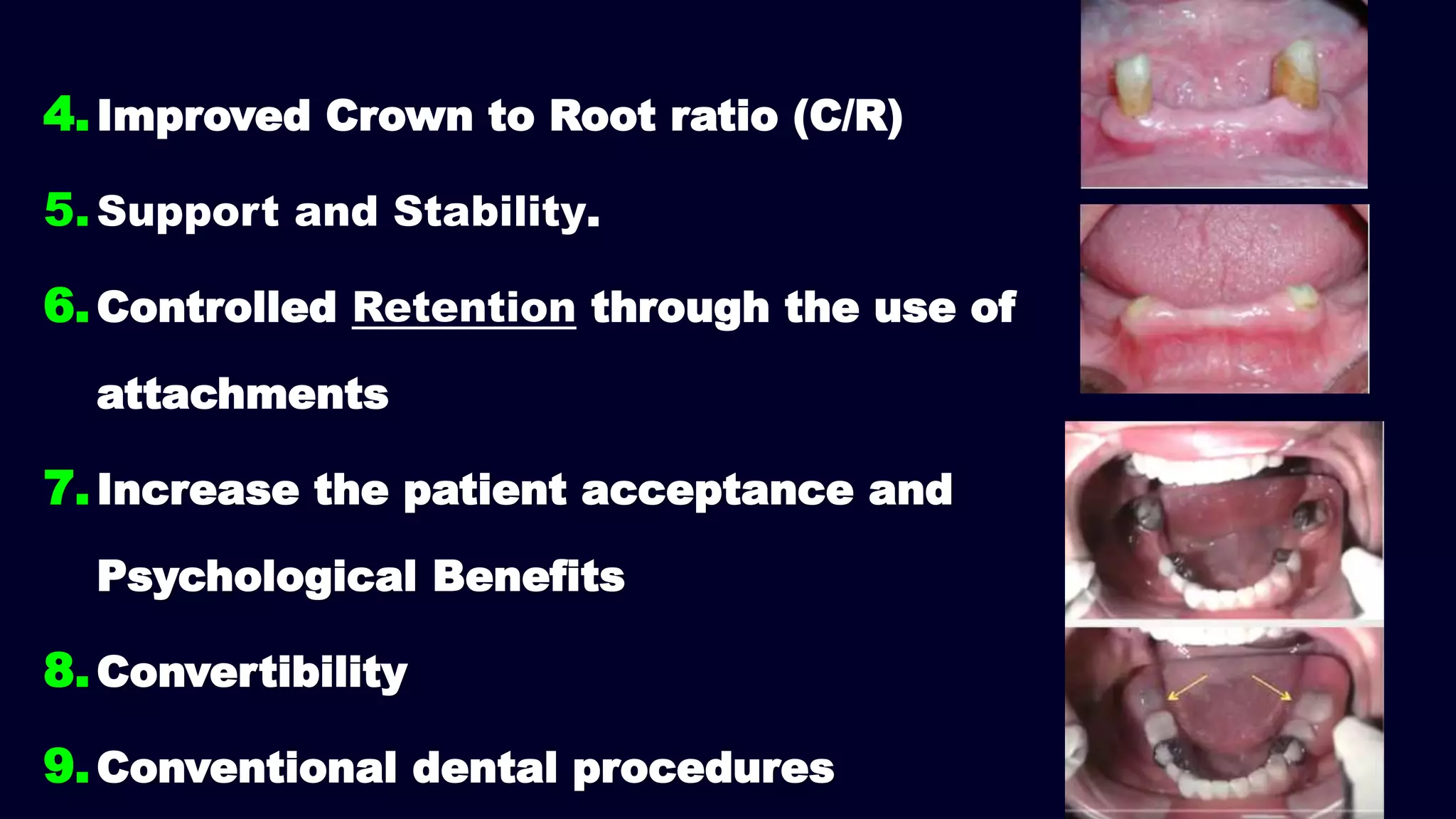 4.Improved Crown to Root ratio (C/R)
5.Support and Stability.
6.Controlled Retention through the use of
attachments
7.Increase the patient acceptance and
Psychological Benefits
8.Convertibility
9.Conventional dental procedures
 