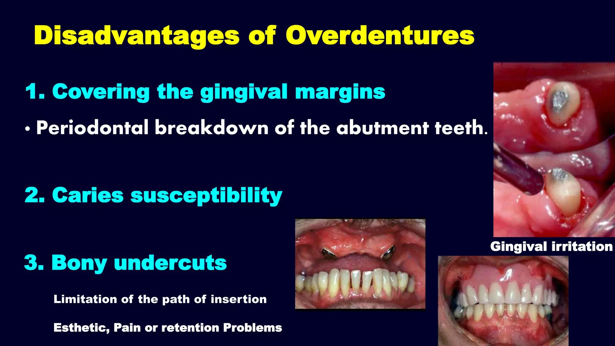Disadvantages of Overdentures
Gingival irritation
1. Covering the gingival margins
• Periodontal breakdown of the abutment teeth.
2. Caries susceptibility
3. Bony undercuts
Limitation of the path of insertion
Esthetic, Pain or retention Problems
 