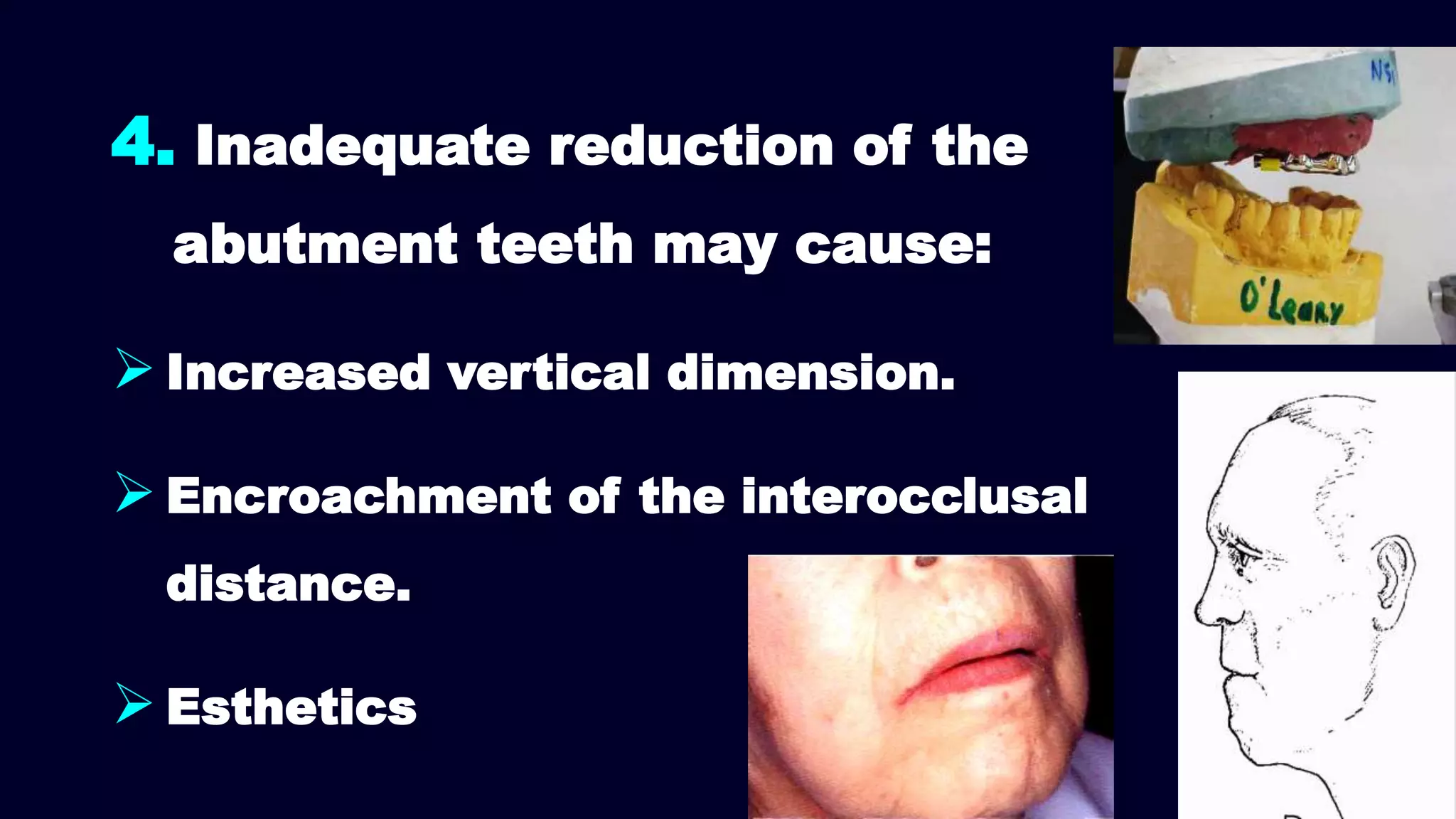 4. Inadequate reduction of the
abutment teeth may cause:
 Increased vertical dimension.
 Encroachment of the interocclusal
distance.
 Esthetics
 