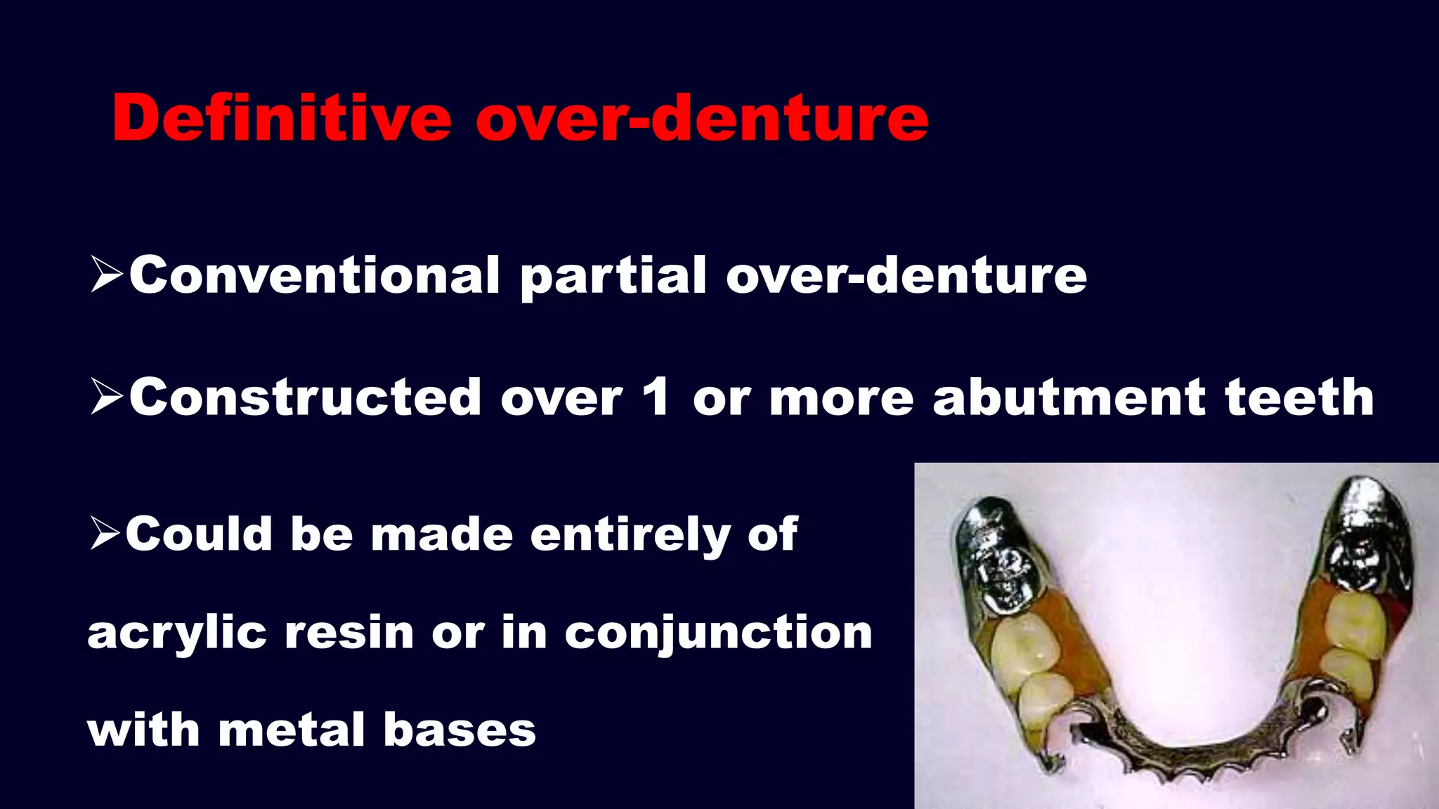 Definitive over-denture
Conventional partial over-denture
Constructed over 1 or more abutment teeth
Could be made entirely of
acrylic resin or in conjunction
with metal bases
 