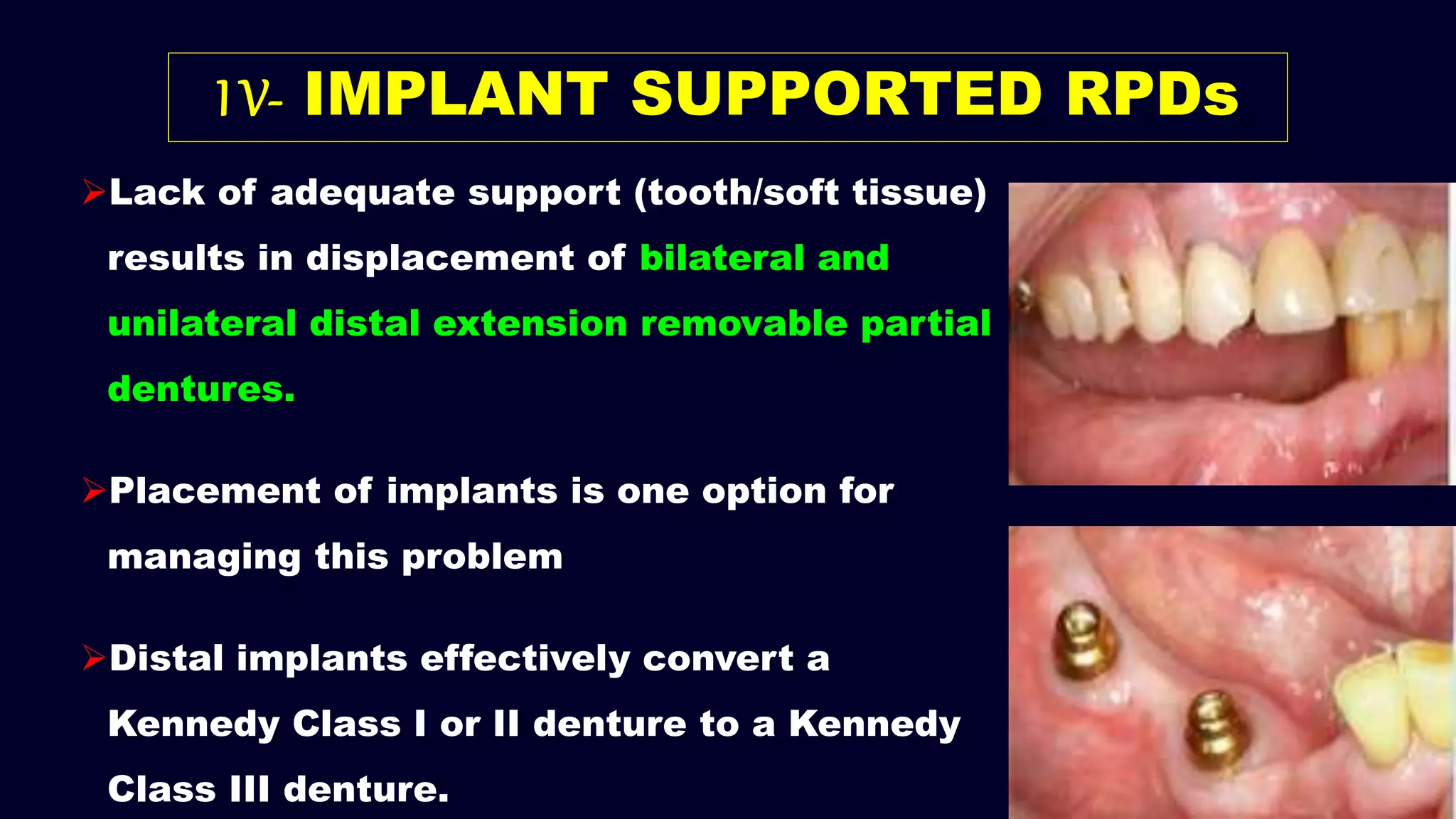 I V- IMPLANT SUPPORTED RPDs
Lack of adequate support (tooth/soft tissue)
results in displacement of bilateral and
unilateral distal extension removable partial
dentures.
Placement of implants is one option for
managing this problem
Distal implants effectively convert a
Kennedy Class I or II denture to a Kennedy
Class III denture.
 