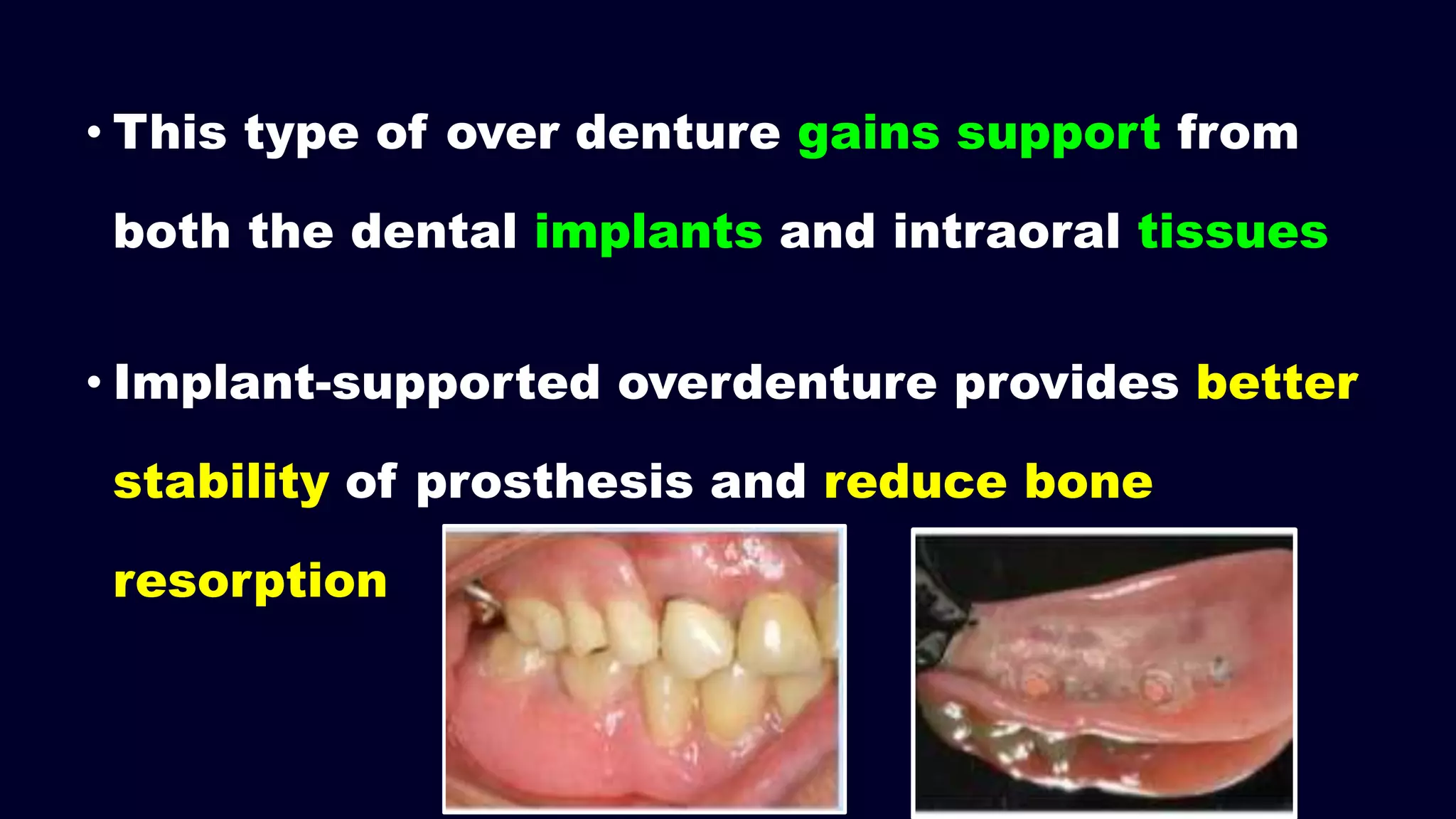 • This type of over denture gains support from
both the dental implants and intraoral tissues
• Implant-supported overdenture provides better
stability of prosthesis and reduce bone
resorption
 