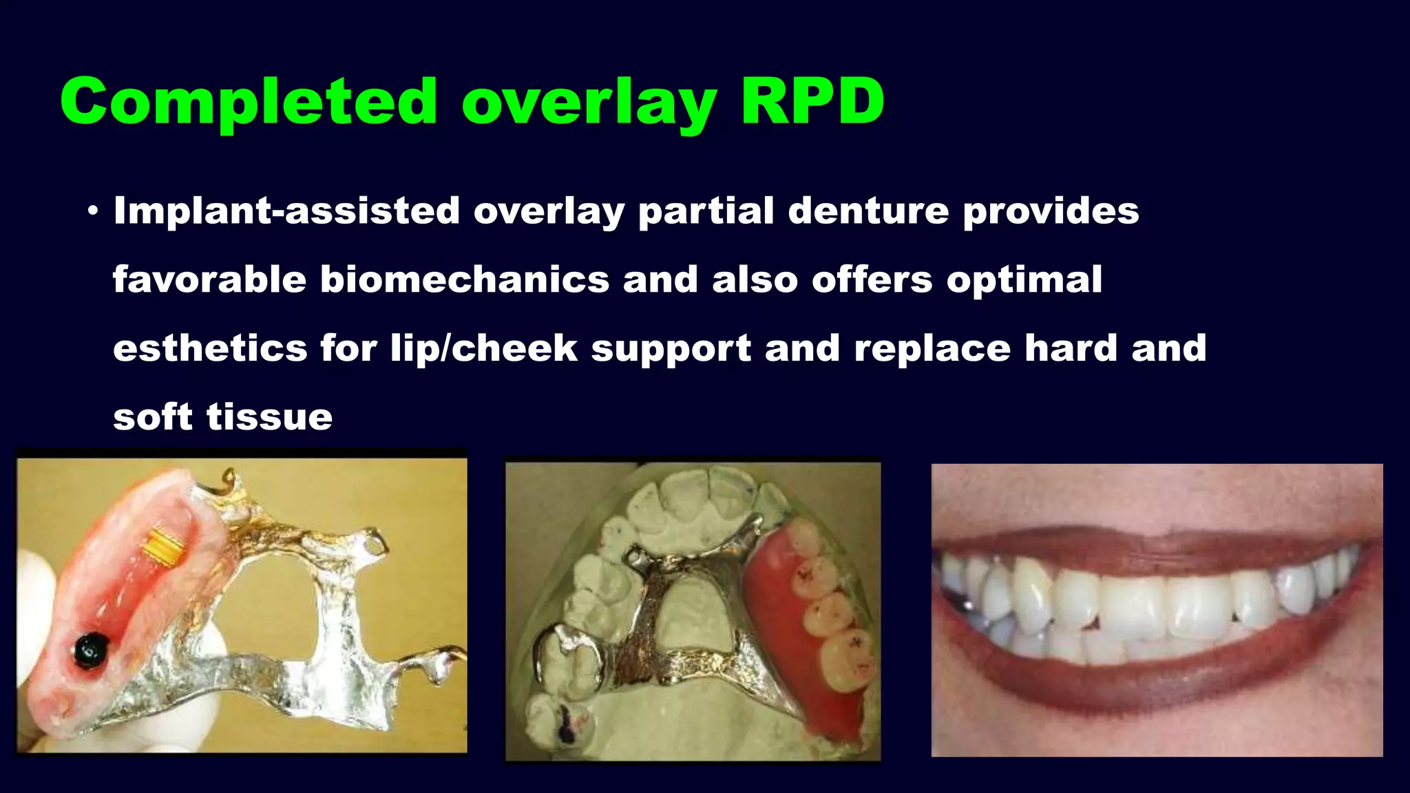 Completed overlay RPD
• Implant-assisted overlay partial denture provides
favorable biomechanics and also offers optimal
esthetics for lip/cheek support and replace hard and
soft tissue
 