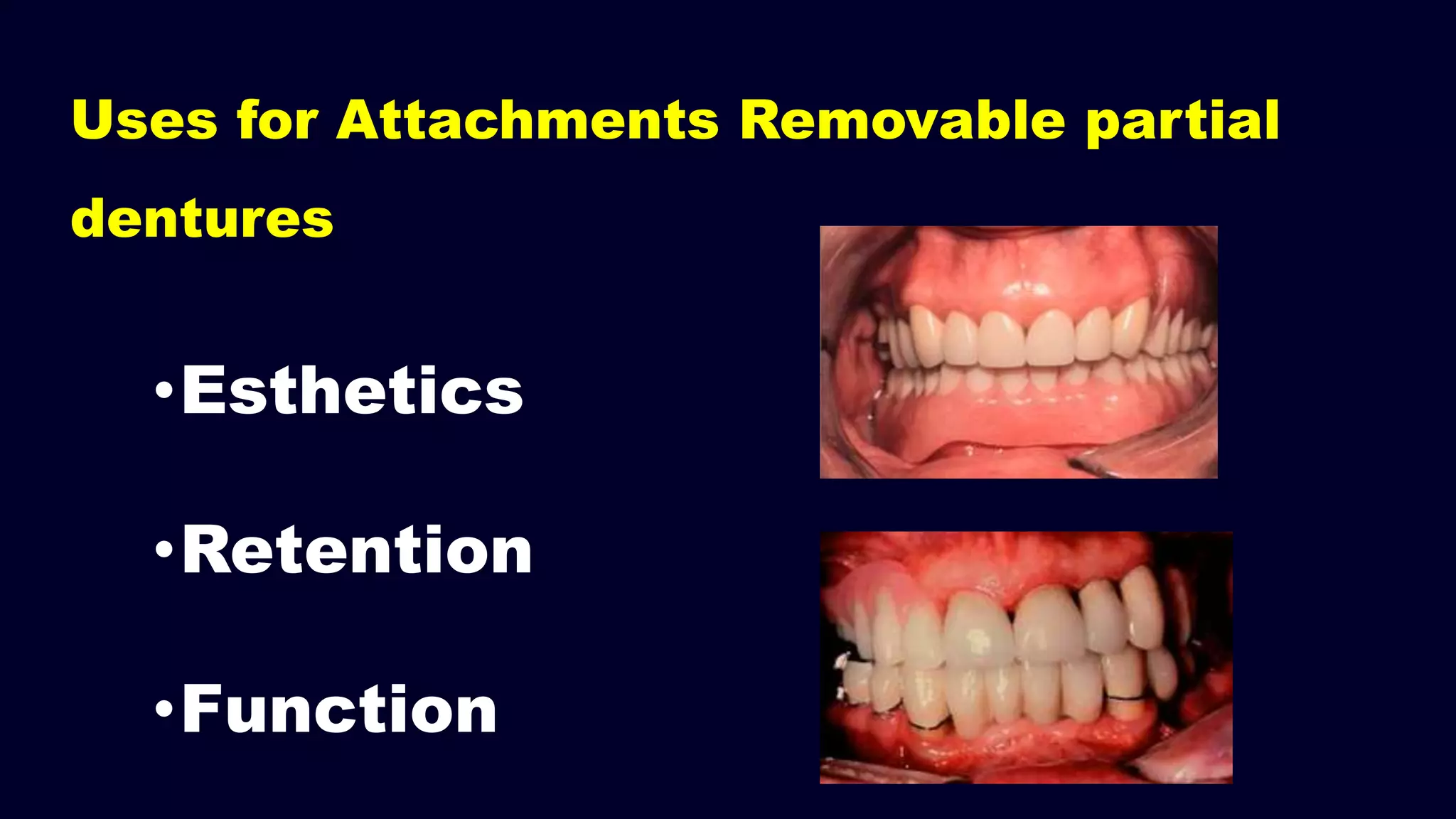 Uses for Attachments Removable partial
dentures
•Esthetics
•Retention
•Function
 