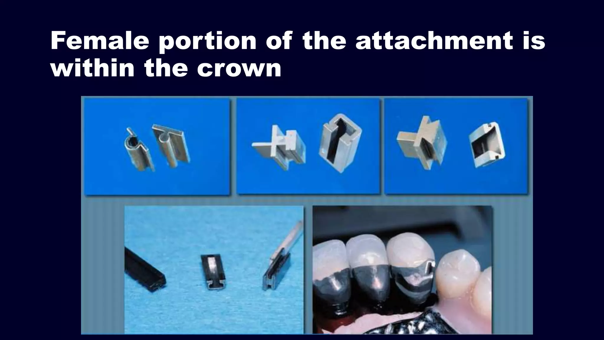 Female portion of the attachment is
within the crown
 