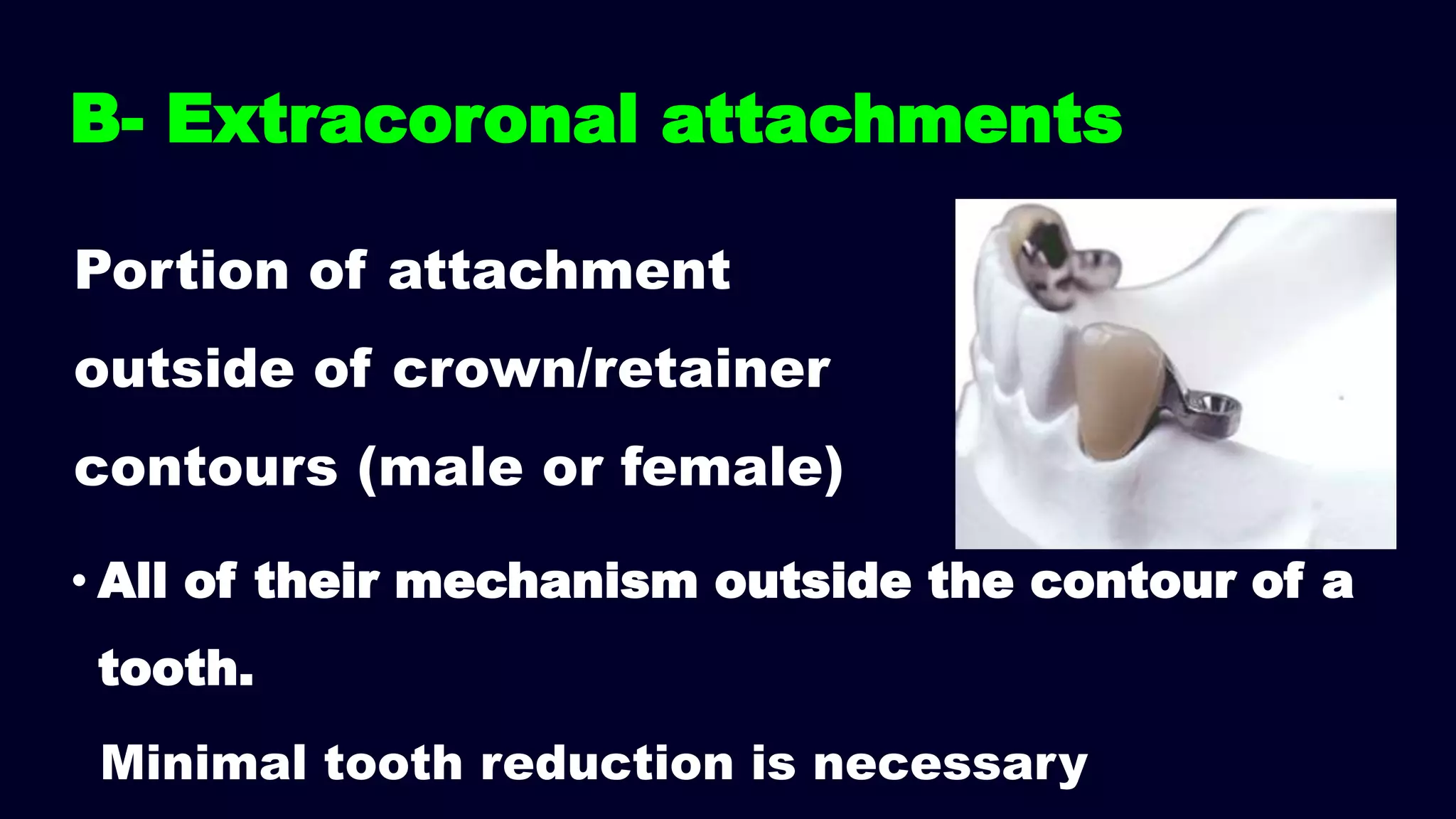 B- Extracoronal attachments
• All of their mechanism outside the contour of a
tooth.
Portion of attachment
outside of crown/retainer
contours (male or female)
Minimal tooth reduction is necessary
 