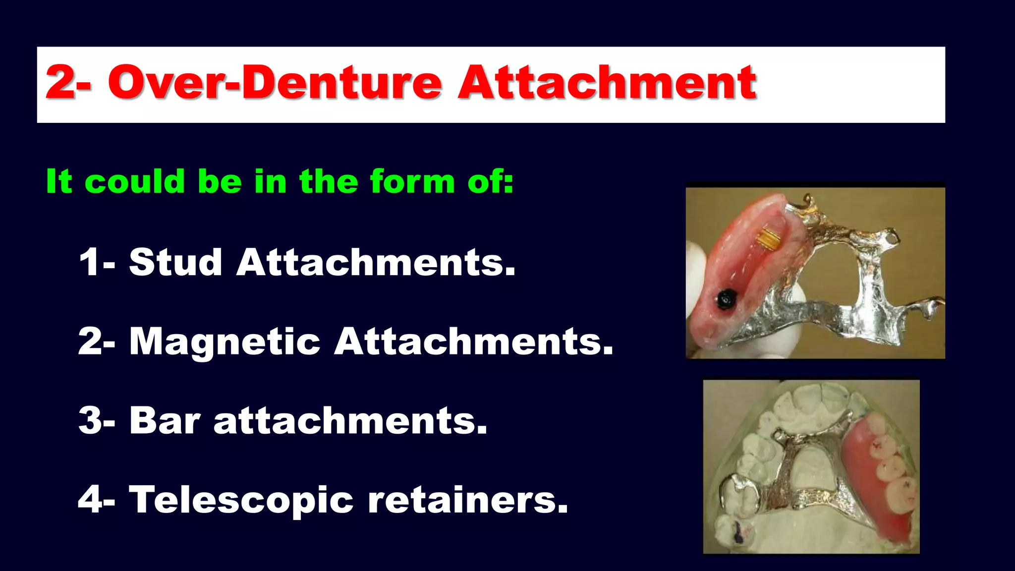 2- Over-Denture Attachment
1- Stud Attachments.
2- Magnetic Attachments.
3- Bar attachments.
4- Telescopic retainers.
It could be in the form of:
 