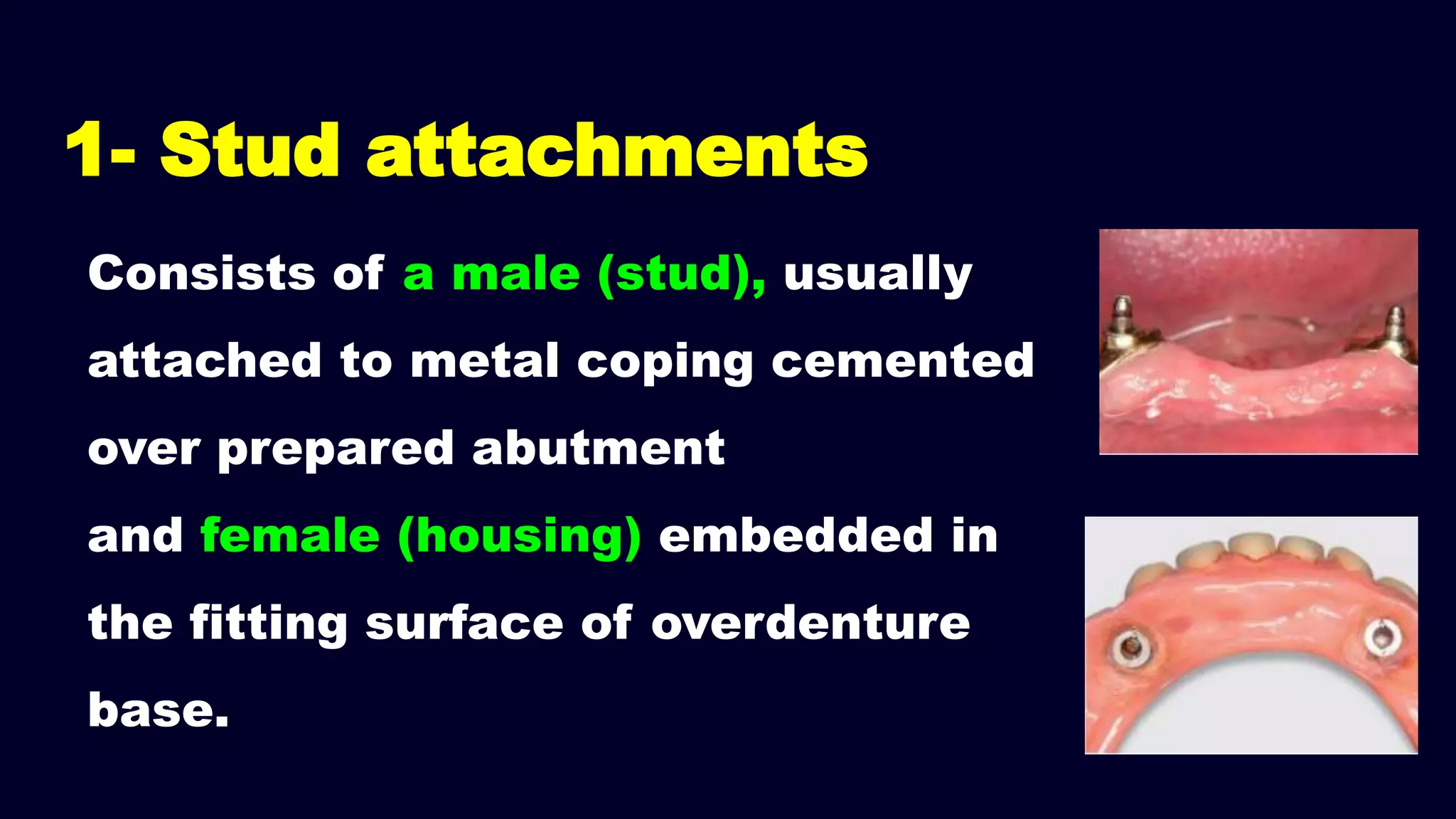 Consists of a male (stud), usually
attached to metal coping cemented
over prepared abutment
and female (housing) embedded in
the fitting surface of overdenture
base.
1- Stud attachments
 