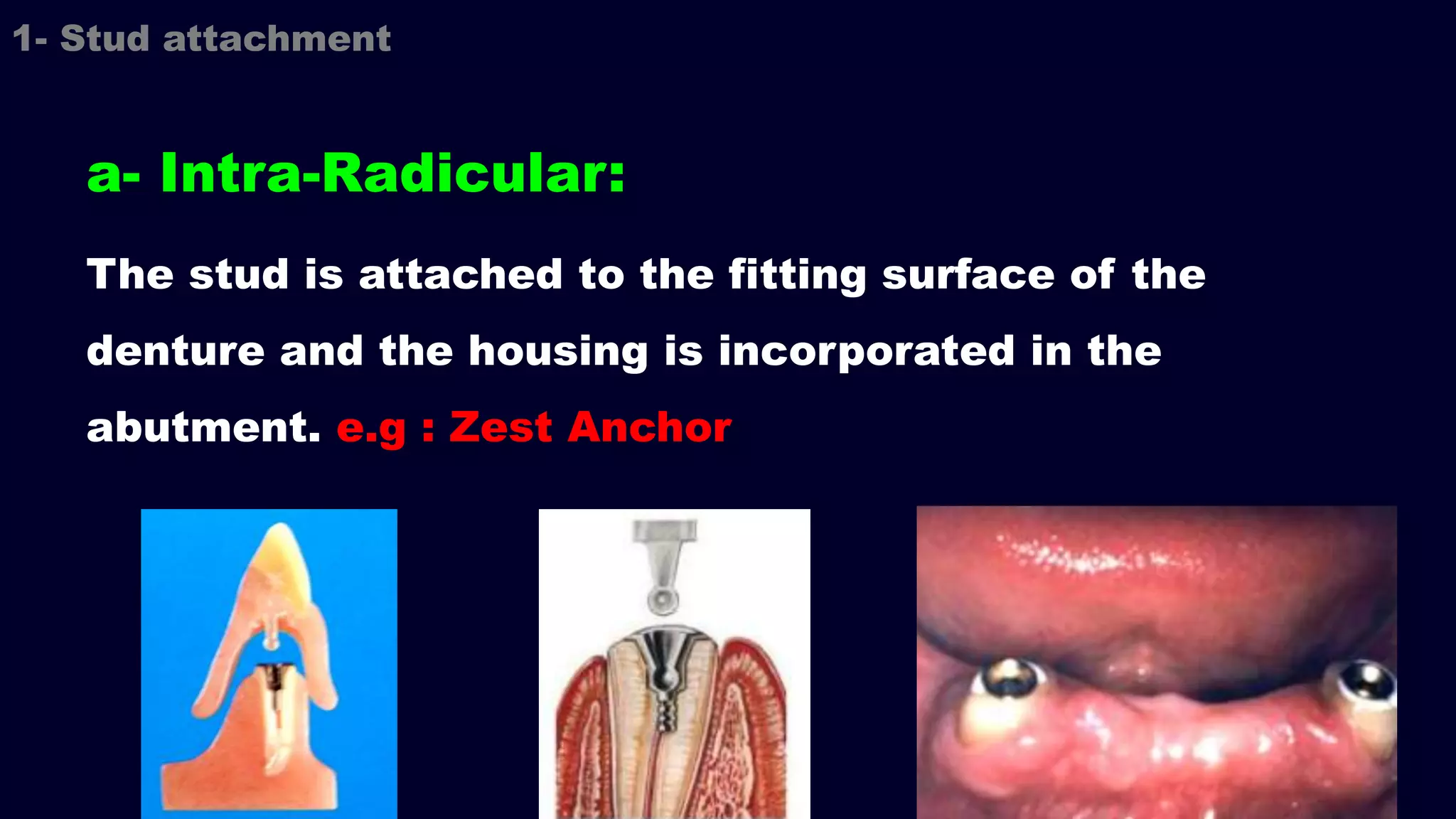 a- Intra-Radicular:
The stud is attached to the fitting surface of the
denture and the housing is incorporated in the
abutment. e.g : Zest Anchor
1- Stud attachment
 