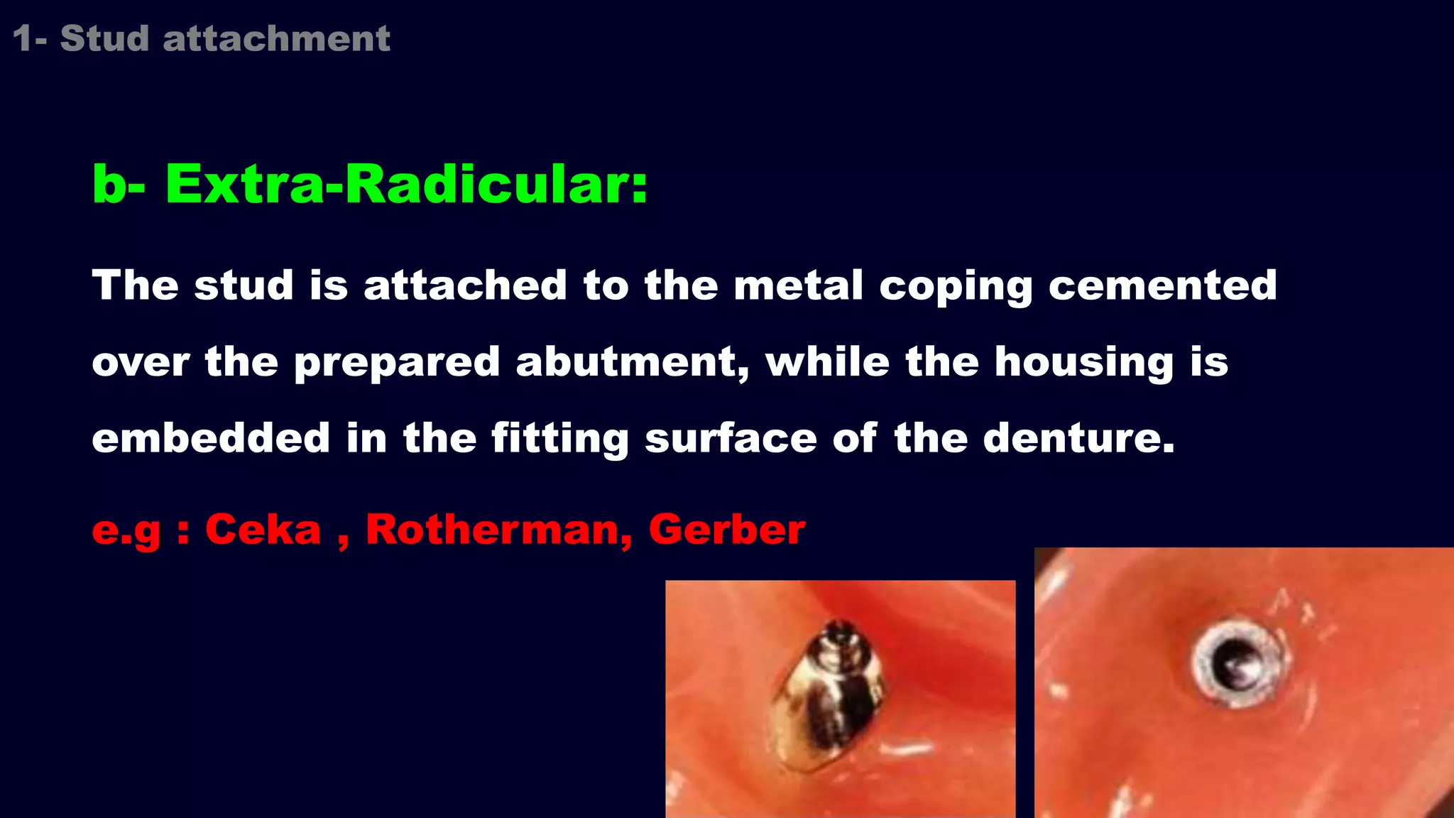 b- Extra-Radicular:
The stud is attached to the metal coping cemented
over the prepared abutment, while the housing is
embedded in the fitting surface of the denture.
e.g : Ceka , Rotherman, Gerber
1- Stud attachment
 