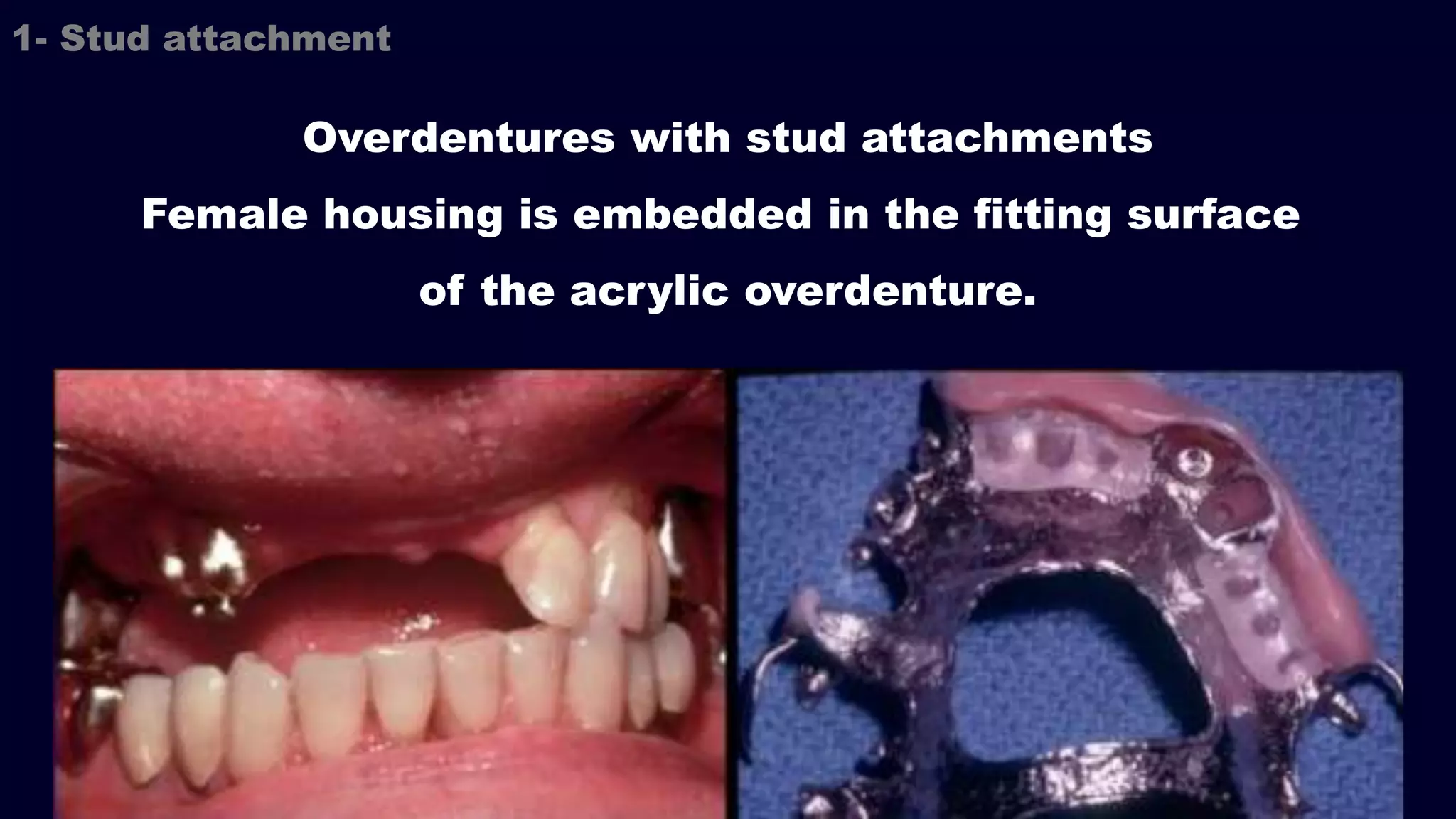 Overdentures with stud attachments
Female housing is embedded in the fitting surface
of the acrylic overdenture.
1- Stud attachment
 