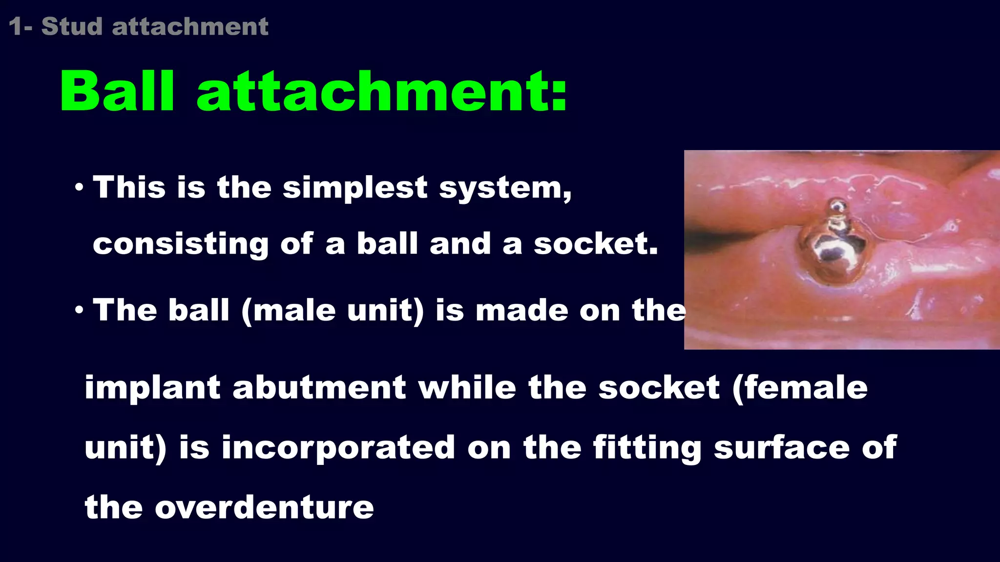Ball attachment:
implant abutment while the socket (female
unit) is incorporated on the fitting surface of
the overdenture
1- Stud attachment
• This is the simplest system,
consisting of a ball and a socket.
• The ball (male unit) is made on the
 
