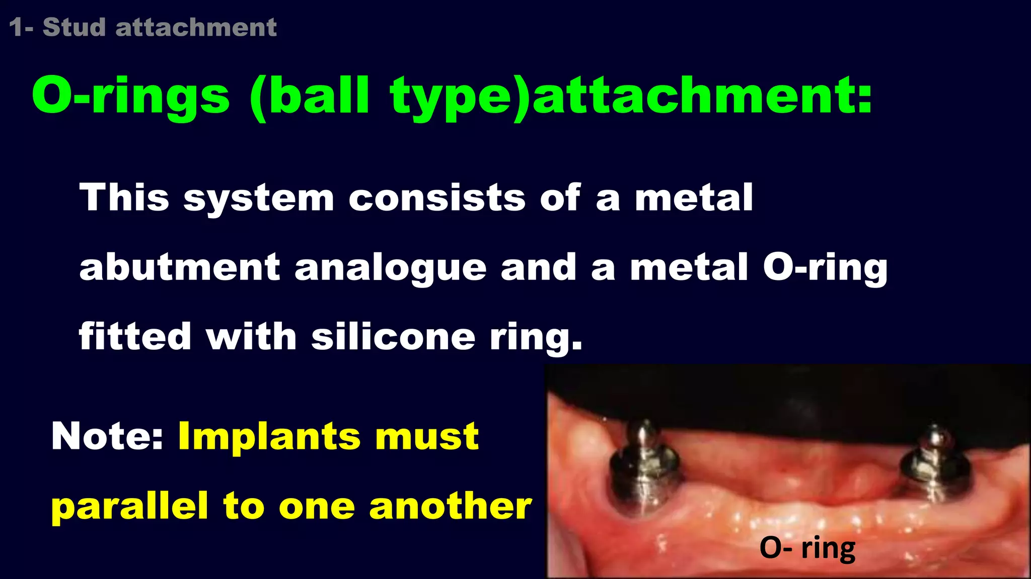 This system consists of a metal
abutment analogue and a metal O-ring
fitted with silicone ring.
O-rings (ball type)attachment:
Note: Implants must
parallel to one another
O- ring
1- Stud attachment
 