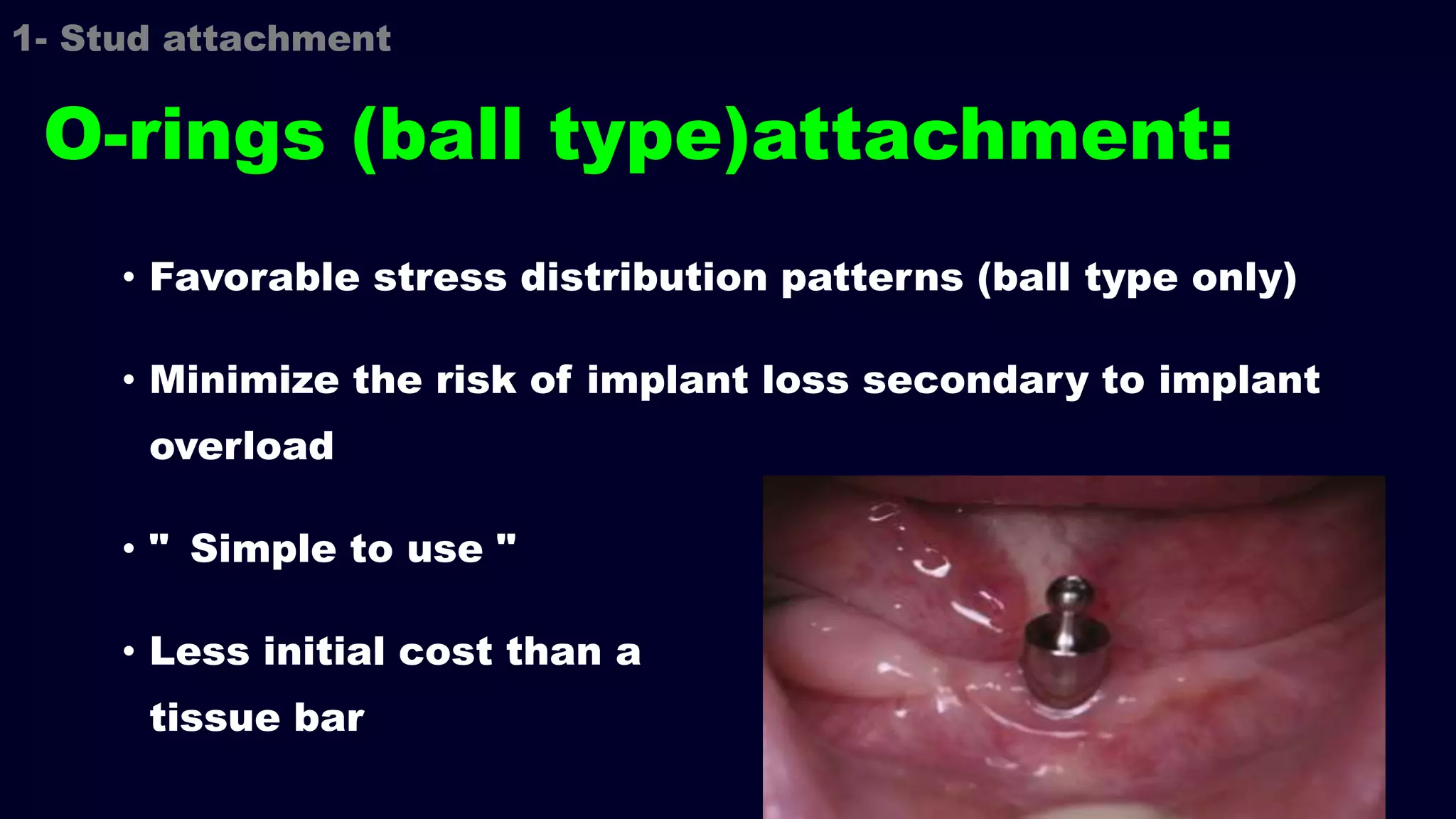 • Favorable stress distribution patterns (ball type only)
• Minimize the risk of implant loss secondary to implant
overload
• " Simple to use "
• Less initial cost than a
tissue bar
O-rings (ball type)attachment:
1- Stud attachment
 