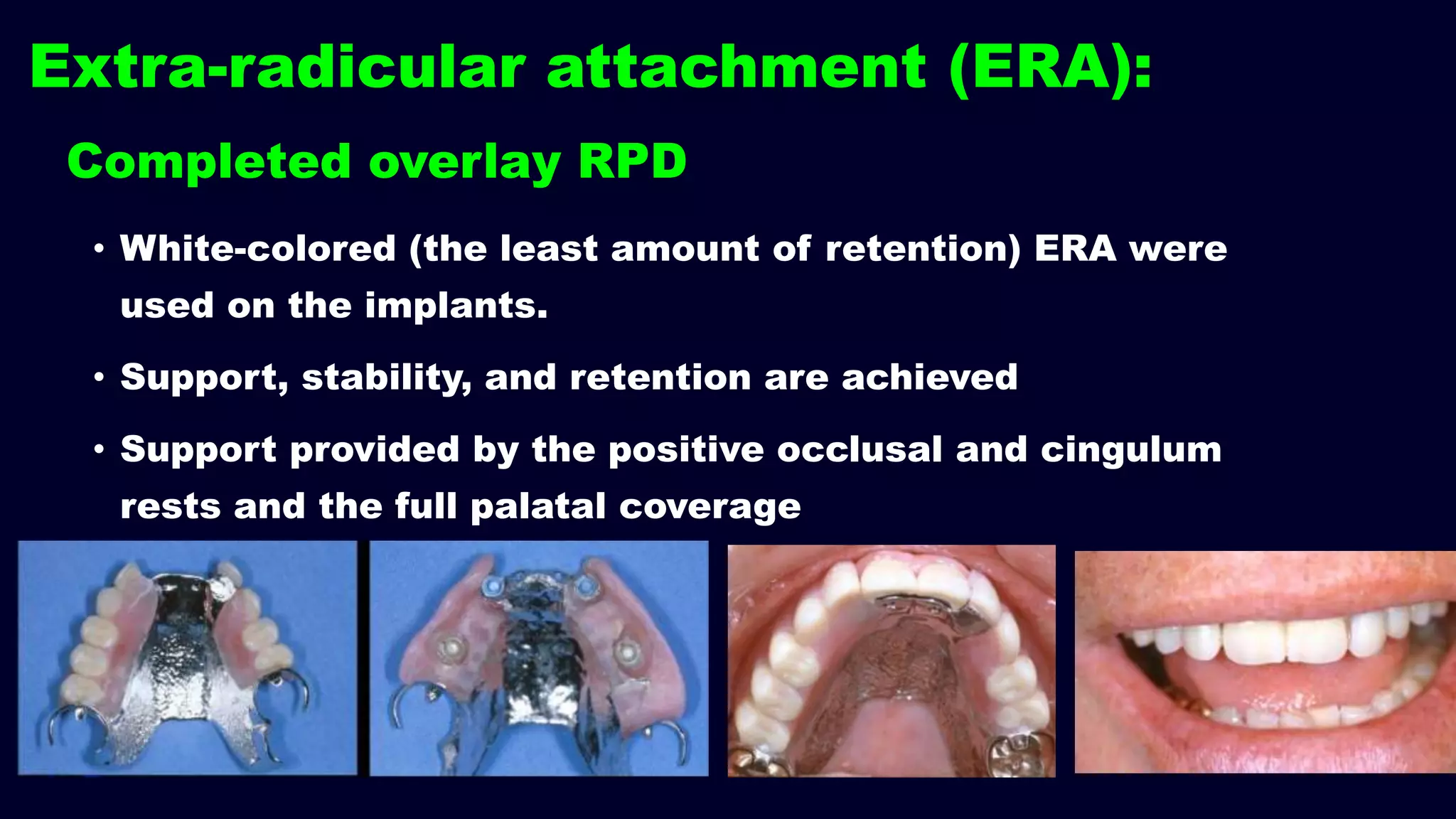 Completed overlay RPD
• White-colored (the least amount of retention) ERA were
used on the implants.
• Support, stability, and retention are achieved
• Support provided by the positive occlusal and cingulum
rests and the full palatal coverage
Extra-radicular attachment (ERA):
 