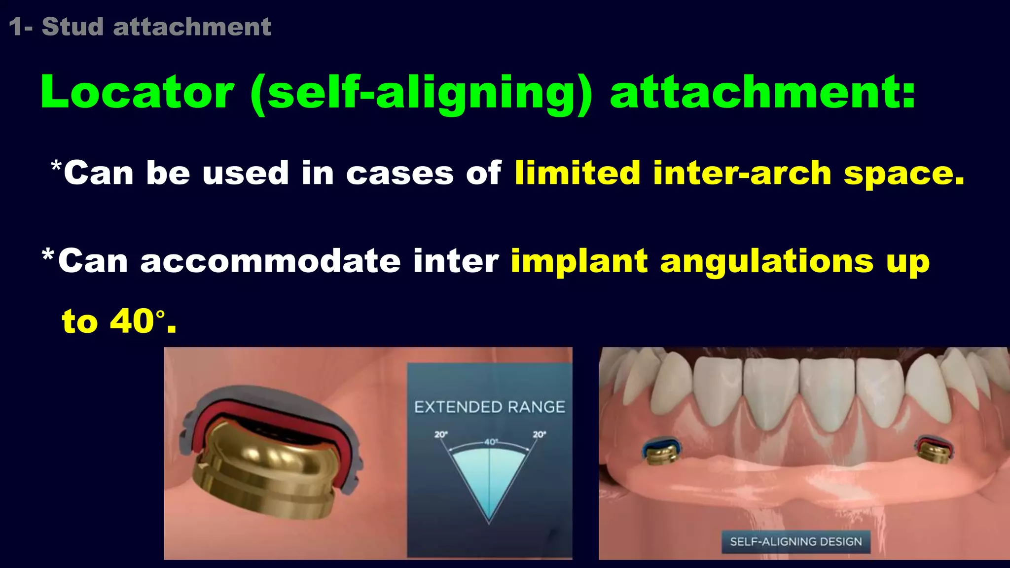 *Can be used in cases of limited inter-arch space.
*Can accommodate inter implant angulations up
to 40°.
1- Stud attachment
Locator (self-aligning) attachment:
 