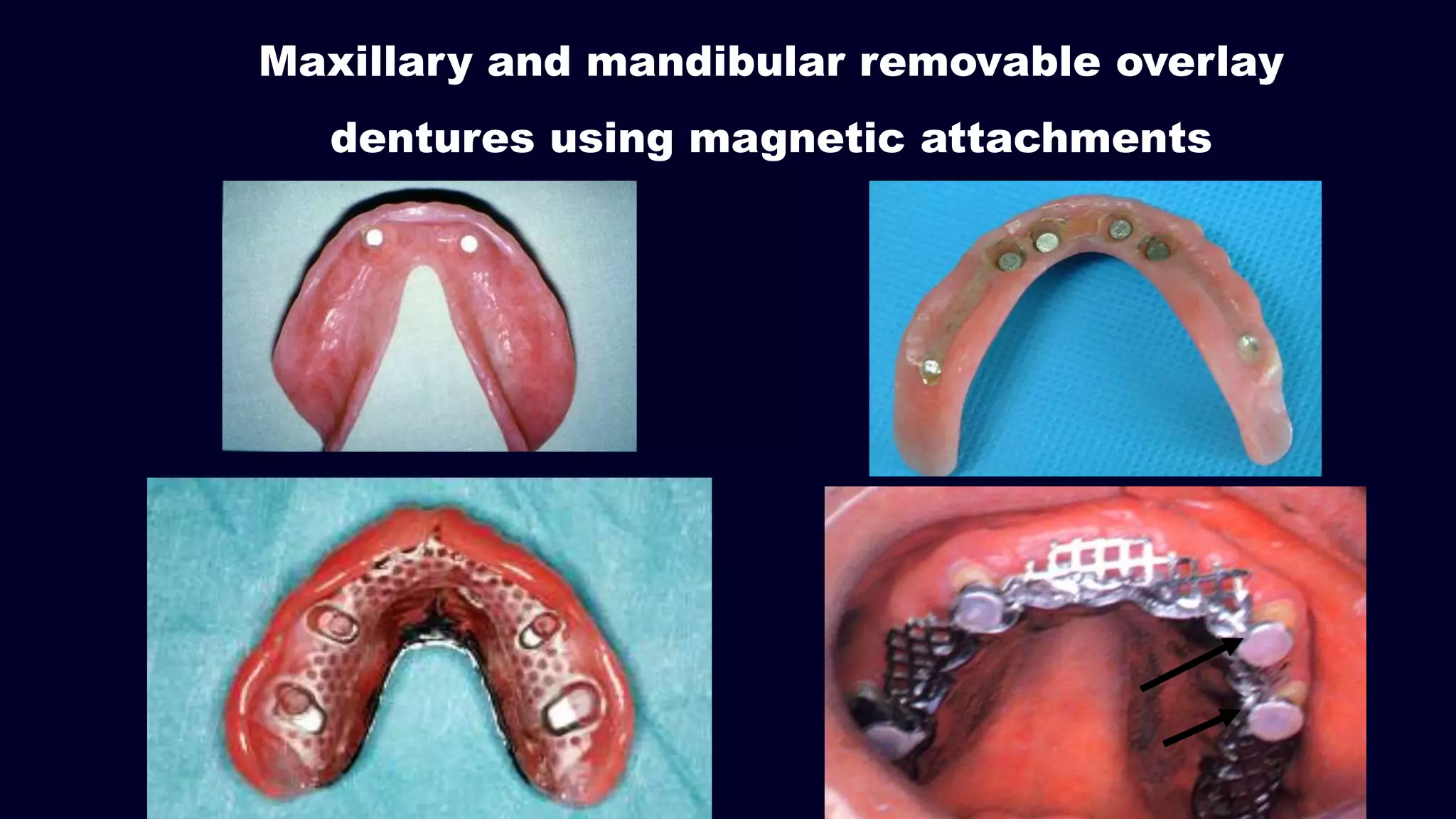 Maxillary and mandibular removable overlay
dentures using magnetic attachments
 
