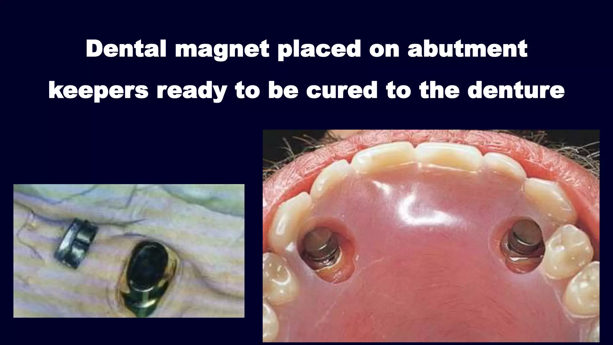 Dental magnet placed on abutment
keepers ready to be cured to the denture
 