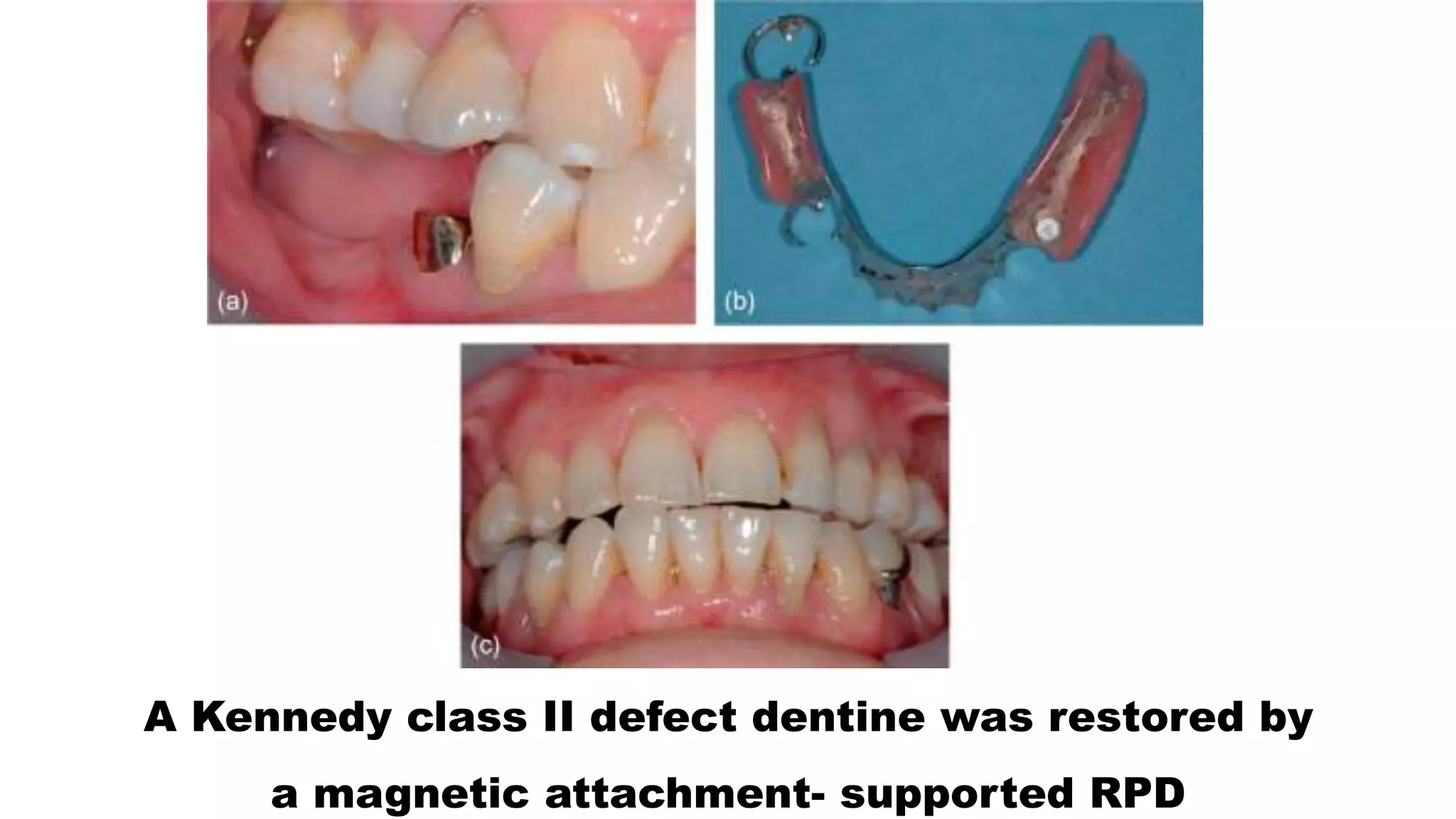 A Kennedy class II defect dentine was restored by
a magnetic attachment- supported RPD
 