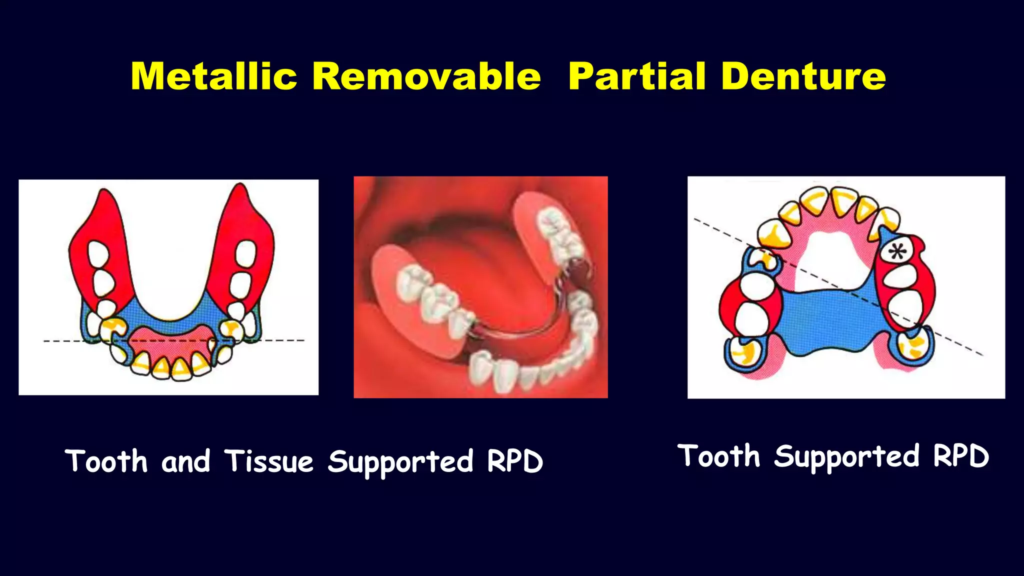 Tooth and Tissue Supported RPD Tooth Supported RPD
Metallic Removable Partial Denture
 