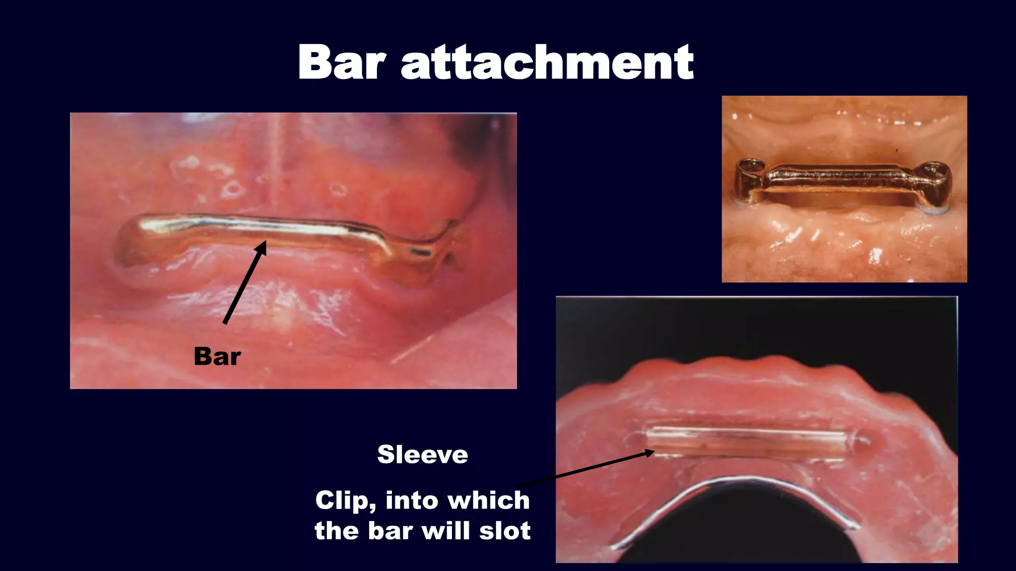 Bar attachment
Sleeve
Clip, into which
the bar will slot
Bar
 