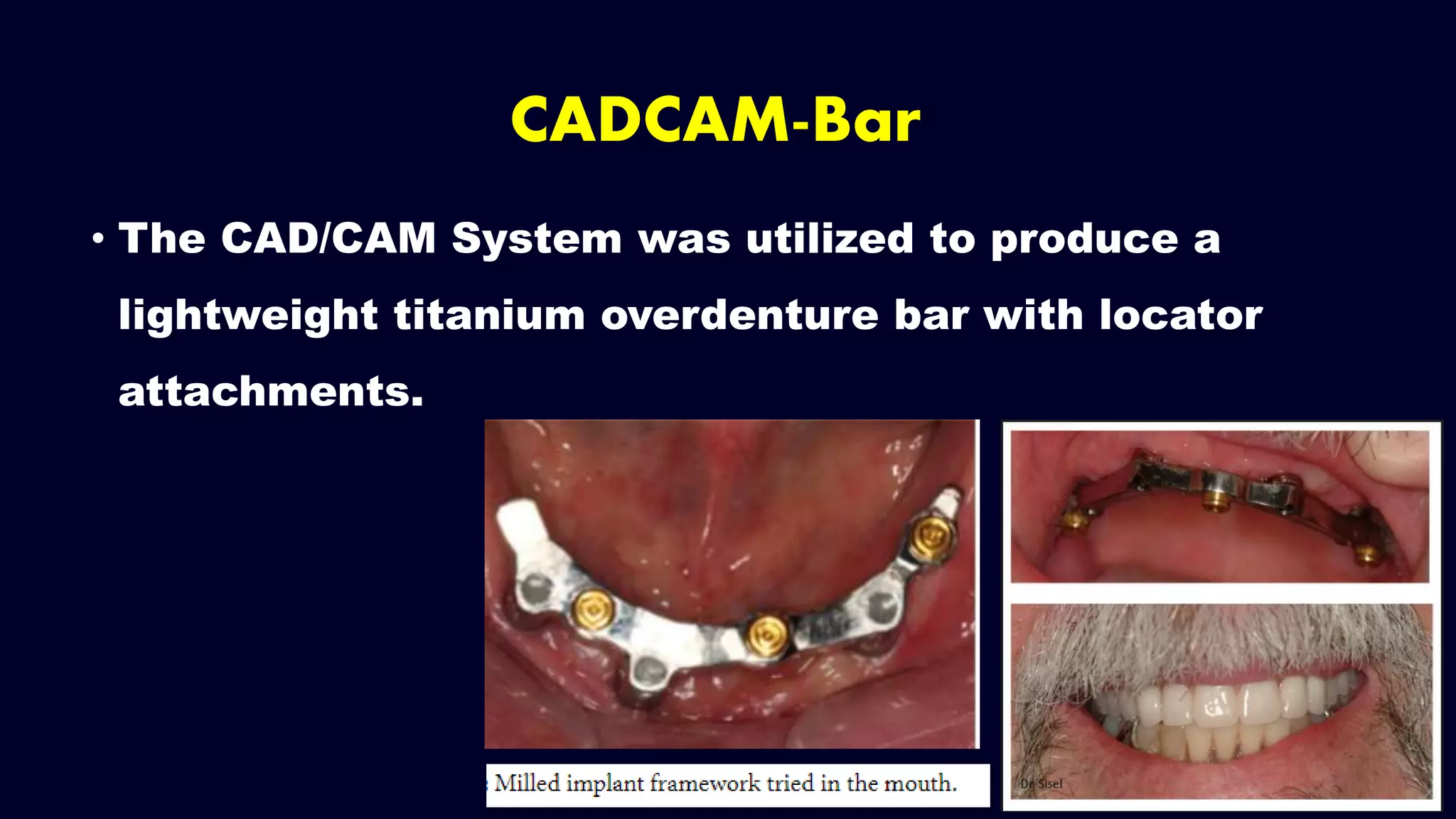 • The CAD/CAM System was utilized to produce a
lightweight titanium overdenture bar with locator
attachments.
CADCAM-Bar
 