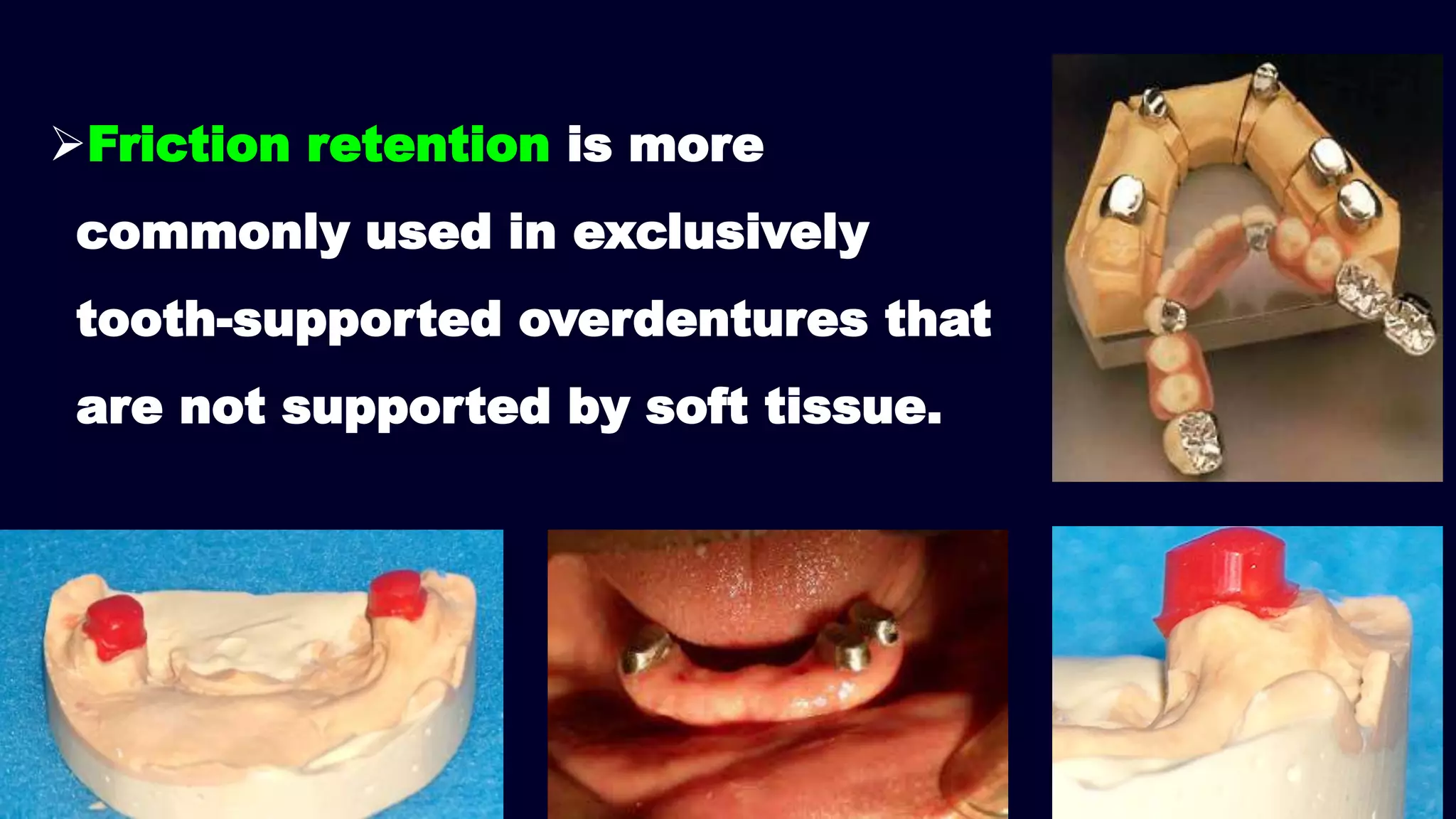 Friction retention is more
commonly used in exclusively
tooth-supported overdentures that
are not supported by soft tissue.
 