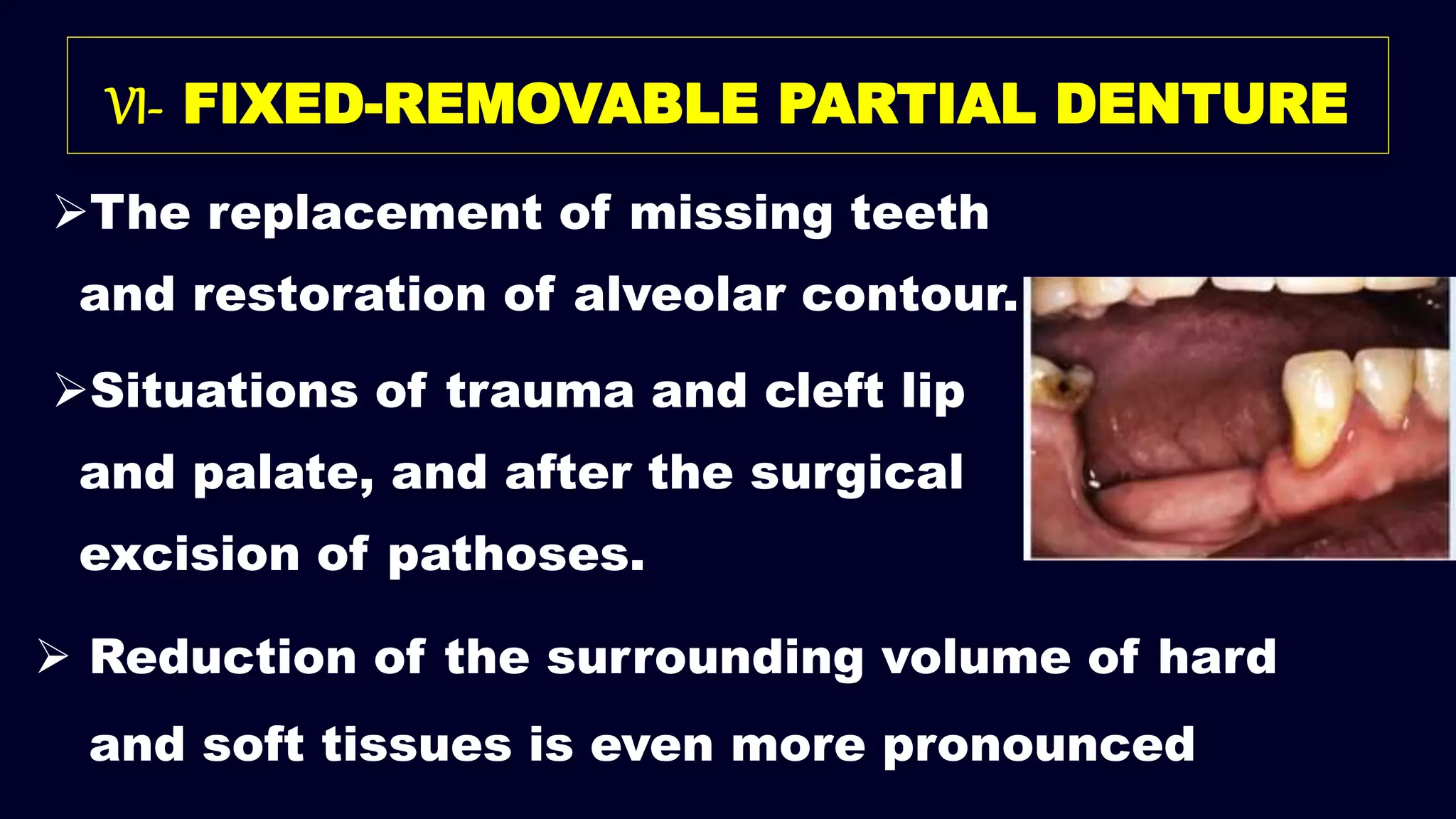 VI- FIXED-REMOVABLE PARTIAL DENTURE
The replacement of missing teeth
and restoration of alveolar contour.
Situations of trauma and cleft lip
and palate, and after the surgical
excision of pathoses.
 Reduction of the surrounding volume of hard
and soft tissues is even more pronounced
 