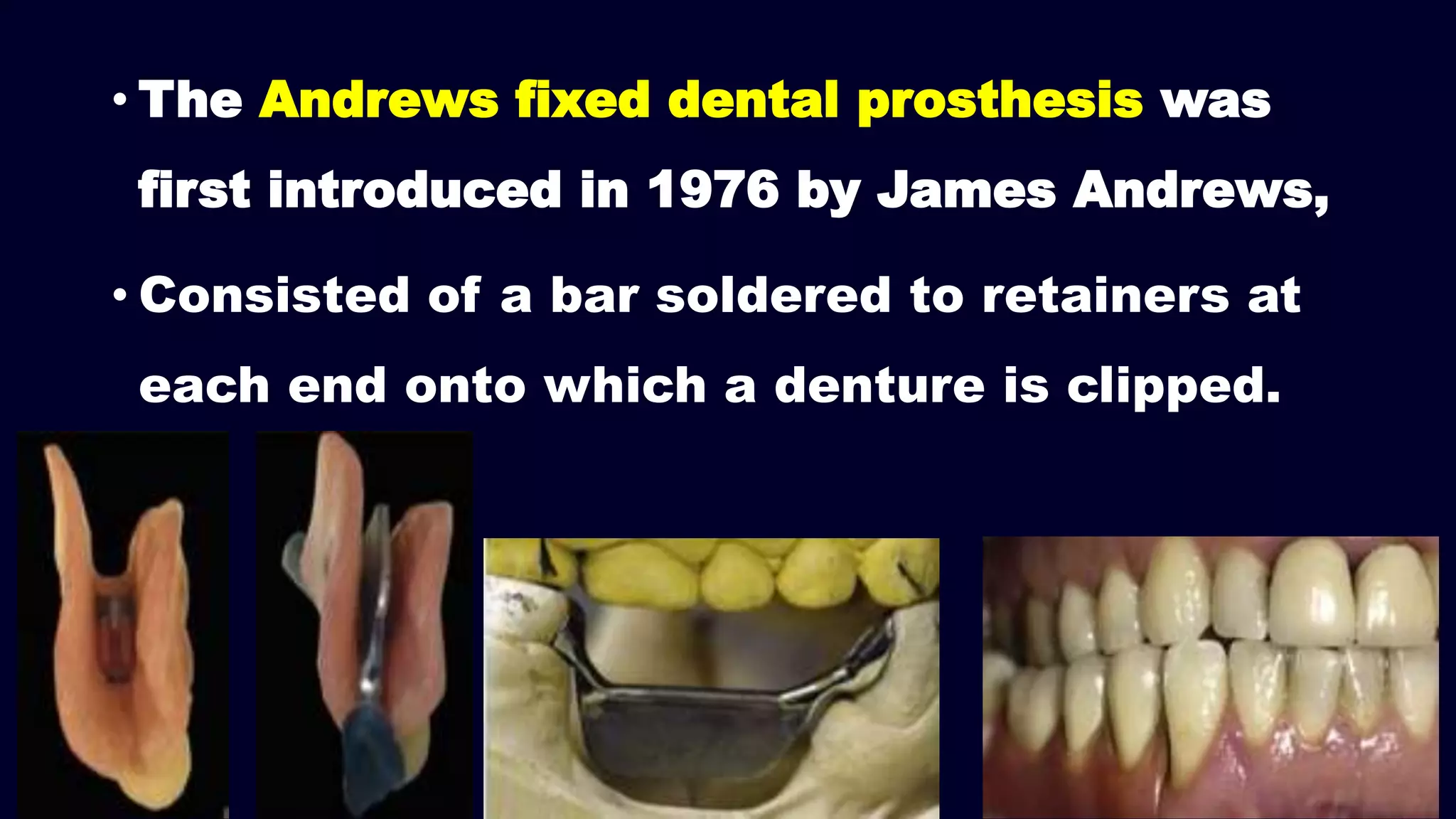 • The Andrews fixed dental prosthesis was
first introduced in 1976 by James Andrews,
• Consisted of a bar soldered to retainers at
each end onto which a denture is clipped.
 