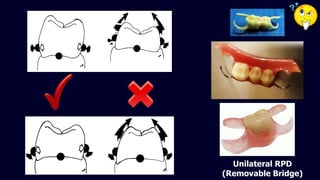 Unilaterl Rpds Other forms of removable partial denture | PPTX