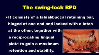 Other forms of removable partial denture | PPTX