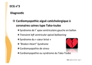ECG	
  n°3	
  
Diagnos3c	
  
"   Cardiomyopathie	
  aiguë	
  catécholergique	
  à	
  
coronaires	
  saines	
  type	
  Tako-­‐tsubo	
  
"  Syndrome	
  de	
  l’apex	
  ventriculaire	
  gauche	
  en	
  ballon	
  	
  
"  Transient	
  le+	
  ventricular	
  apical	
  ballooning	
  
"  Syndrome	
  du	
  «	
  cœur	
  brisé	
  »	
  
"  "Broken-­‐Heart"	
  Syndrome	
  
"  Cardiomyopathie	
  de	
  stress	
  
"  Cardiomyopathie	
  ou	
  syndrome	
  du	
  Tako-­‐Tsubo	
  
CHU_Hôpitaux de Rouen - page 11

 