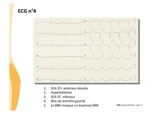 ECG	
  n°4	
  

1. 
2. 
3. 
4. 
5. 

SCA	
  ST+	
  antérieur	
  étendu	
  
Hyperkaliémie	
  
SCA	
  ST-­‐	
  inférieur	
  
Bloc	
  de	
  branche	
  gauche	
  
Le	
  BBG	
  masque	
  un	
  éventuel	
  IDM	
  

CHU_Hôpitaux de Rouen - page 14

 