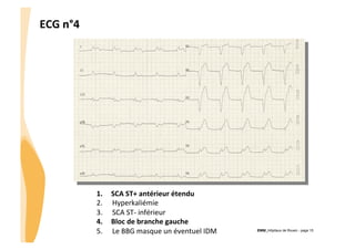 ECG	
  n°4	
  

1.  SCA	
  ST+	
  antérieur	
  étendu	
  
2.  Hyperkaliémie	
  
3.  SCA	
  ST-­‐	
  inférieur	
  
4.  Bloc	
  de	
  branche	
  gauche	
  
5.  Le	
  BBG	
  masque	
  un	
  éventuel	
  IDM	
  

CHU_Hôpitaux de Rouen - page 15

 