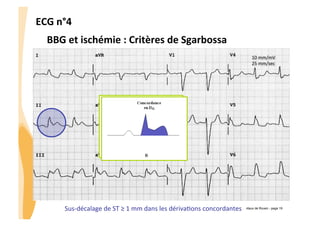 ECG	
  n°4	
  
BBG	
  et	
  ischémie	
  :	
  Critères	
  de	
  Sgarbossa	
  	
  
10	
  mm/mV	
  
25	
  mm/sec	
  

CHU_Hôpitaux de Rouen - page 19
Sus-­‐décalage	
  de	
  ST	
  ≥	
  1	
  mm	
  dans	
  les	
  dérivaGons	
  concordantes	
  

 
