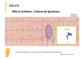 ECG	
  n°4	
  
BBG	
  et	
  ischémie	
  :	
  Critères	
  de	
  Sgarbossa	
  	
  
10	
  mm/mV	
  
25	
  mm/sec	
  

Sus-­‐décalage	
  de	
  ST	
  ≥	
  5	
  mm	
  dans	
  les	
  dérivaGons	
  discordantes	
  
CHU_Hôpitaux de Rouen - page 21

 