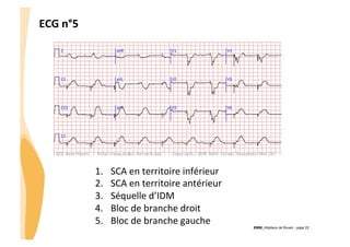 ECG	
  n°5	
  

1. 
2. 
3. 
4. 
5. 

SCA	
  en	
  territoire	
  inférieur	
  
SCA	
  en	
  territoire	
  antérieur	
  
Séquelle	
  d’IDM	
  
Bloc	
  de	
  branche	
  droit	
  
Bloc	
  de	
  branche	
  gauche	
  

CHU_Hôpitaux de Rouen - page 22

 