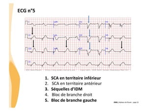 ECG	
  n°5	
  

1. 
2. 
3. 
4. 
5. 

SCA	
  en	
  territoire	
  inférieur	
  
SCA	
  en	
  territoire	
  antérieur	
  
Séquelles	
  d’IDM	
  
Bloc	
  de	
  branche	
  droit	
  
Bloc	
  de	
  branche	
  gauche	
  

CHU_Hôpitaux de Rouen - page 23

 