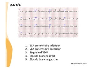 ECG	
  n°6	
  

1. 
2. 
3. 
4. 
5. 

SCA	
  en	
  territoire	
  inférieur	
  
SCA	
  en	
  territoire	
  antérieur	
  
Séquelle	
  d’IDM	
  
Bloc	
  de	
  branche	
  droit	
  
Bloc	
  de	
  branche	
  gauche	
  
CHU_Hôpitaux de Rouen - page 24

 