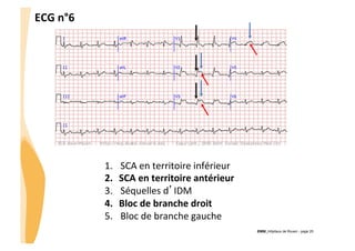 ECG	
  n°6	
  

1. 
2. 
3. 
4. 
5. 

SCA	
  en	
  territoire	
  inférieur	
  
SCA	
  en	
  territoire	
  antérieur	
  
Séquelles	
  d’IDM	
  
Bloc	
  de	
  branche	
  droit	
  
Bloc	
  de	
  branche	
  gauche	
  
CHU_Hôpitaux de Rouen - page 25

 