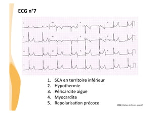 ECG	
  n°7	
  

1. 
2. 
3. 
4. 
5. 

SCA	
  en	
  territoire	
  inférieur	
  
Hypothermie	
  
Péricardite	
  aiguë	
  
Myocardite	
  
RepolarisaGon	
  précoce	
  

!

CHU_Hôpitaux de Rouen - page 27

 
