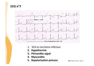 ECG	
  n°7	
  

1. 
2. 
3. 
4. 
5. 

SCA	
  en	
  territoire	
  inférieur	
  
Hypothermie	
  
Péricardite	
  aiguë	
  
Myocardite	
  
Repolarisa3on	
  précoce	
  

!

CHU_Hôpitaux de Rouen - page 28

 