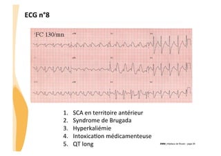 ECG	
  n°8	
  

1. 
2. 
3. 
4. 
5. 

SCA	
  en	
  territoire	
  antérieur	
  
Syndrome	
  de	
  Brugada	
  
Hyperkaliémie	
  
IntoxicaGon	
  médicamenteuse	
  
QT	
  long	
  

CHU_Hôpitaux de Rouen - page 29

 