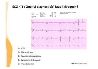 ECG	
  n°1	
  :	
  Quel(s)	
  diagnos3c(s)	
  faut-­‐il	
  évoquer	
  ?	
  

1)  HVG	
  

!

2)  SCA	
  antérieur	
  
3)  RepolarisaGon	
  précoce	
  
4)  Syndrome	
  de	
  Brugada	
  
5)  Hyperkaliémie	
  

CHU_Hôpitaux de Rouen - page 3

 