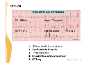 ECG	
  n°8	
  

1. 
2. 
3. 
4. 
5. 

SCA	
  en	
  territoire	
  antérieur	
  
Syndrome	
  de	
  Brugada	
  
Hyperkaliémie	
  
Intoxica3on	
  médicamenteuse	
  
QT	
  long	
  

CHU_Hôpitaux de Rouen - page 30

 
