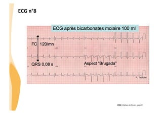 ECG	
  n°8	
  

CHU_Hôpitaux de Rouen - page 31

 