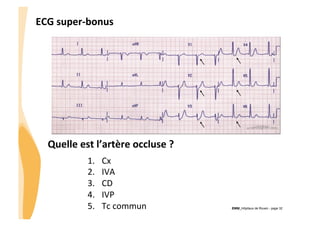 ECG	
  super-­‐bonus	
  

Quelle	
  est	
  l’artère	
  occluse	
  ?	
  
1. 
2. 
3. 
4. 
5. 

Cx	
  
IVA	
  
CD	
  
IVP	
  
Tc	
  commun	
  

CHU_Hôpitaux de Rouen - page 32

 