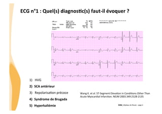 ECG	
  n°1	
  :	
  Quel(s)	
  diagnos3c(s)	
  faut-­‐il	
  évoquer	
  ?	
  

1)  HVG	
  

!

2)  SCA	
  antérieur	
  
3)  RepolarisaGon	
  précoce	
  
4)  Syndrome	
  de	
  Brugada	
  
5)  Hyperkaliémie	
  

Wang	
  K.	
  et	
  al.	
  ST-­‐Segment	
  ElevaGon	
  in	
  CondiGons	
  Other	
  Than	
  
Acute	
  Myocardial	
  InfarcGon.	
  NEJM	
  2003.349:2128-­‐2135	
  	
  
CHU_Hôpitaux de Rouen - page 4

 