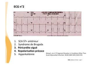 ECG	
  n°2	
  

!

1. 
2. 
3. 
4. 
5. 

SCA	
  ST+	
  antérieur	
  
Syndrome	
  de	
  Brugada	
  
Péricardite	
  aiguë	
  
Repolarisa3on	
  précoce	
  
Hyperkaliémie	
  

Wang	
  K.	
  et	
  al.	
  ST-­‐Segment	
  ElevaGon	
  in	
  CondiGons	
  Other	
  Than	
  
Acute	
  Myocardial	
  InfarcGon.	
  NEJM	
  2003.349:2128-­‐2135	
  	
  
CHU_Hôpitaux de Rouen - page 7

 