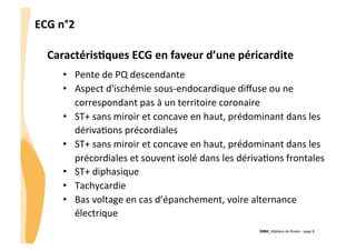 ECG	
  n°2	
  
Caractéris3ques	
  ECG	
  en	
  faveur	
  d’une	
  péricardite	
  
•  Pente	
  de	
  PQ	
  descendante	
  
•  Aspect	
  d'ischémie	
  sous-­‐endocardique	
  diﬀuse	
  ou	
  ne	
  
correspondant	
  pas	
  à	
  un	
  territoire	
  coronaire	
  
•  ST+	
  sans	
  miroir	
  et	
  concave	
  en	
  haut,	
  prédominant	
  dans	
  les	
  
dérivaGons	
  précordiales	
  
•  ST+	
  sans	
  miroir	
  et	
  concave	
  en	
  haut,	
  prédominant	
  dans	
  les	
  
précordiales	
  et	
  souvent	
  isolé	
  dans	
  les	
  dérivaGons	
  frontales	
  
•  ST+	
  diphasique	
  
•  Tachycardie	
  
•  Bas	
  voltage	
  en	
  cas	
  d’épanchement,	
  voire	
  alternance	
  
électrique	
  
CHU_Hôpitaux de Rouen - page 8

 